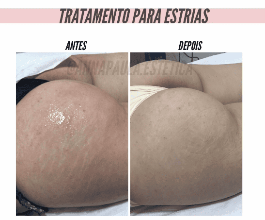 Comparativo real de tratamento para estrias acompanhado pela clínica
