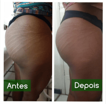 Imagem real de tratamento para estrias realizado na clínica