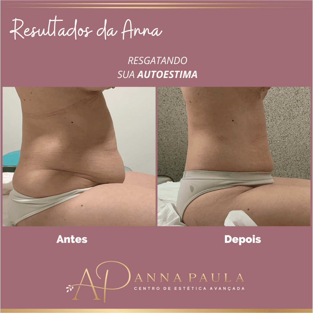 Resultado real de tratamento para gordura localizada na clínica Anna Paula Estética