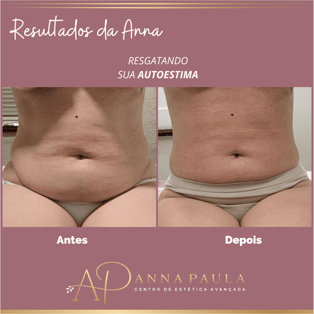 Resultado real de paciente atendida para gordura localizada