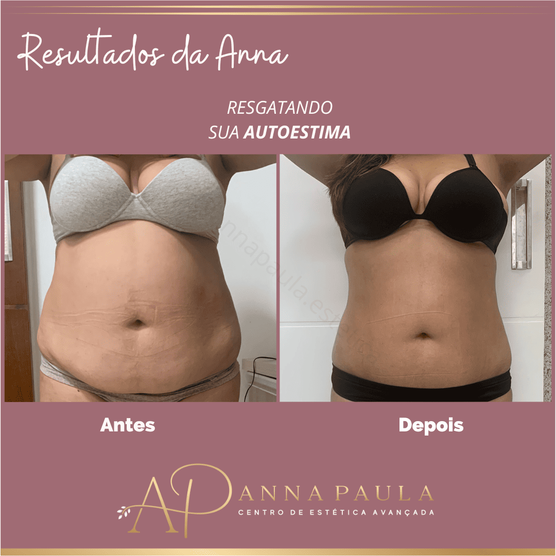 Comparativo de resultado real de gordura localizada