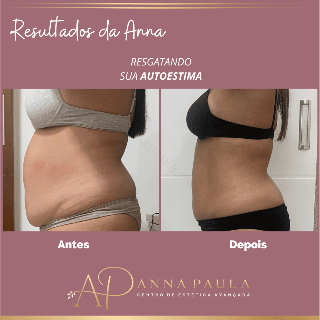 Resultado corporal real em tratamento para gordura localizada