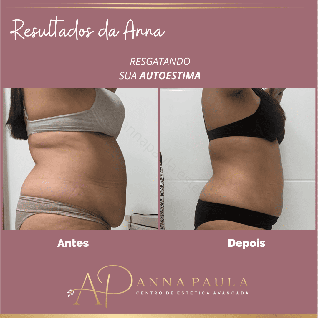 Evolução real de paciente em tratamento para gordura localizada