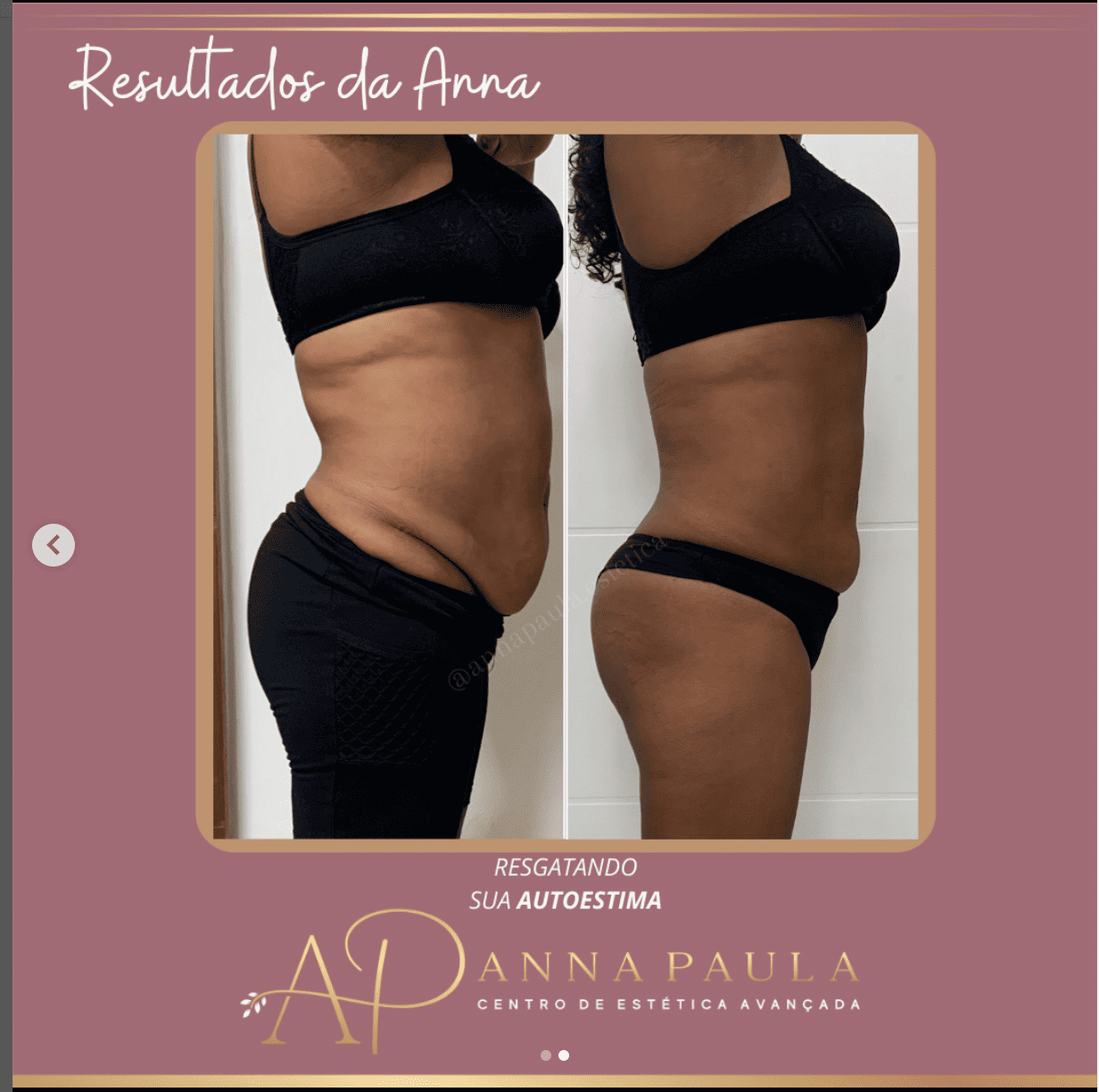 Antes e depois real de paciente da clínica