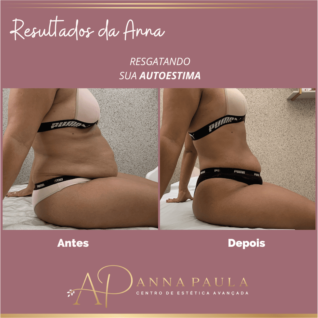 Resultado real de gordura localizada com acompanhamento da clínica