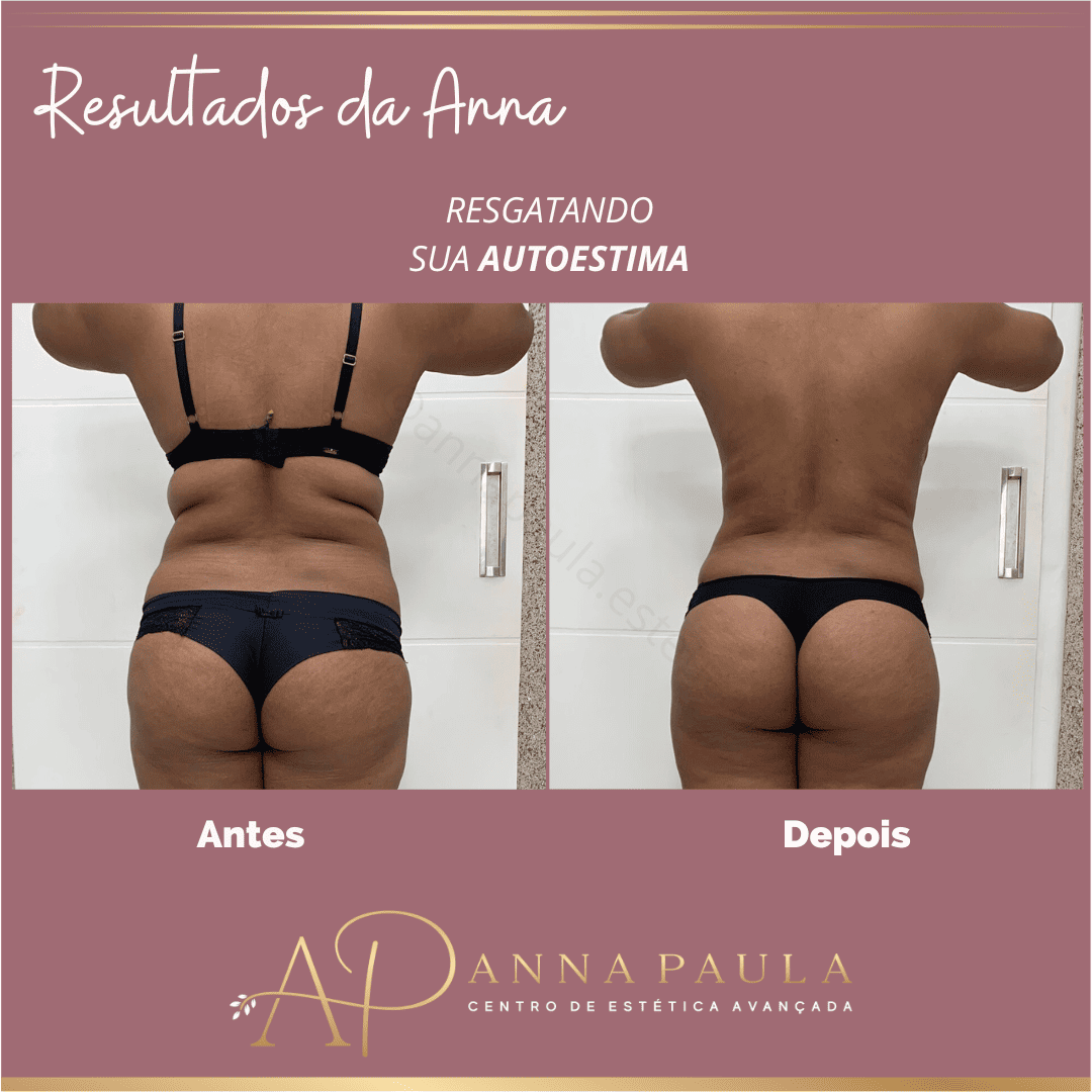 Resultado real apresentado pela clínica Anna Paula Estética