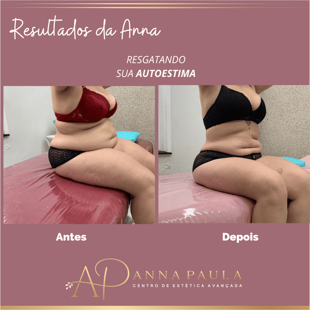 Evolução visual real de tratamento corporal na clínica